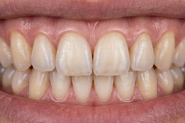 rehabilitacion oral before